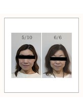 ミヤビ(miyabi)/小顔矯正