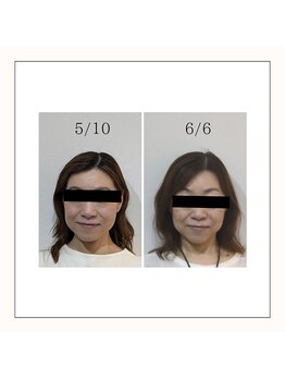 ミヤビ(miyabi)/小顔矯正