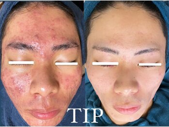 22クラレ(22curare)/何をしてもダメだったトラブルに