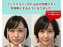 ピュアハリ/沖縄那覇美容鍼灸/小顔/たるみ