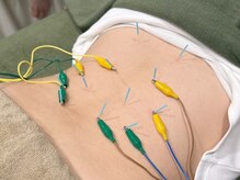 しゅんぷう/【鍼灸/鍼】