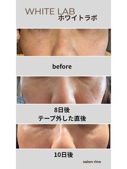 サロン リノ(salon rino)の写真/結果重視◎格上のシミ改善体験!7日後の変化。60日後の確かな結果へ。隠す肌から自信の持てる素肌へ!