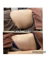 ベルビー エルエル岡崎店/お腹-痩身2回