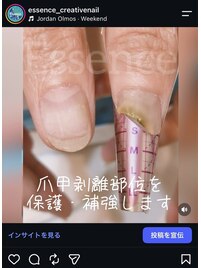 爪甲剥離もご相談ください。