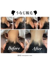 ナナ(nana)/自慢のうなじ脱毛♪