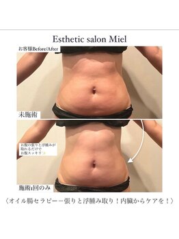ミエル 神戸店(Miel)/腸オイルセラピーで浮腫スッキリ