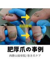 どうはく堂 西勝山接骨院/肥厚した爪