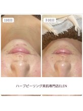 エレン(Elen)/ニキビ、赤みの鎮静ケア