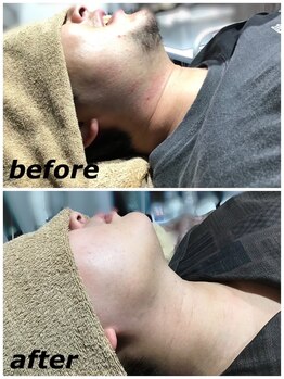 サヴァージュ(Sauvage)/髭脱毛 10回 before／after