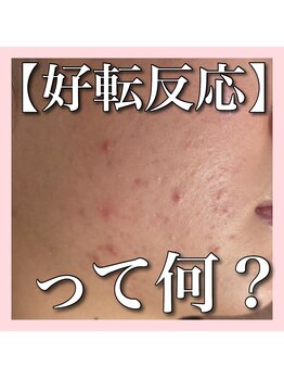 アルムダアクア 天王寺店(Aleumda AQUA)/ハーブピーリング/大阪/天王寺