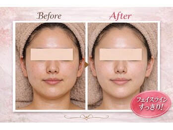 ベルビー エルエル岡崎店/美肌ビフォーアフター