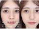 眉毛アイブロウサロン&α新潟店 眉毛サロン/眉毛/アイブロウ/まゆげ/眉毛間引き/眉毛の写真/【眉毛サロン】眉毛だけでなく顔全体WAX脱毛◎眉毛を整え産毛のない,すっぴん美人へ♪美眉/眉毛/アイブロウ