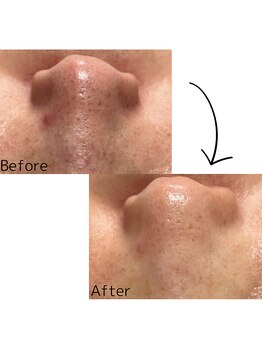 アットウィル 志木店(at will)/毛穴洗浄BeforeAfter