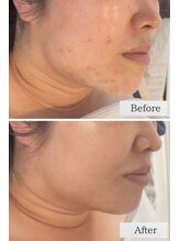 トゥモロー(TOMORROW)/ハーブピーリング/肌質改善