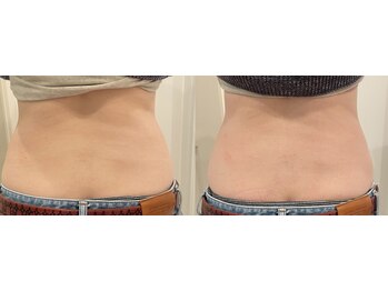 ルナート(Lunart)/腸もみの一回の変化