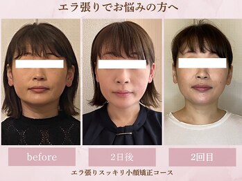 フラン(franc)/スッキリ小顔矯正コース
