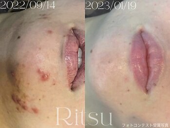 リツ(Ritsu)/頑固なアゴニキビケア