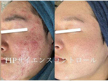 ソリッジ肌管理室/大人気TIP集中プログラム　