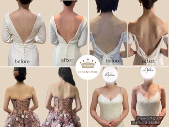 クイーンズ ピュア 恵比寿店(Queen's Pure)/二の腕シェイプ
