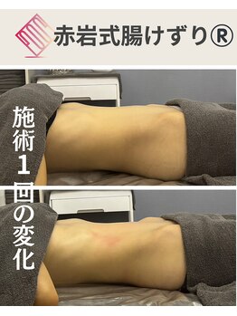 リア(Lia)/30代女性施術1回の効果