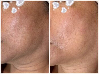 プルメリスタ 八千代緑が丘店/光フェイシャル(施術１回)