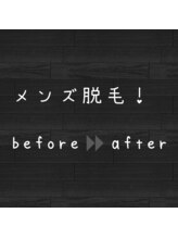 エアレ(eare)/大人気メンズ脱毛！
