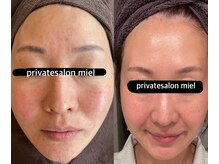 ミエル(miel)/【ハーブピーリング】ニキビ赤み