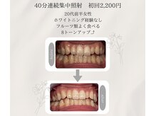 プラスビーセルフ(+b self)/ホワイトニングビフォーアフター