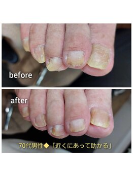 爪切り屋 足楽/70代男性の爪ケア