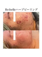 サラ/Re:belleハーブピーリング