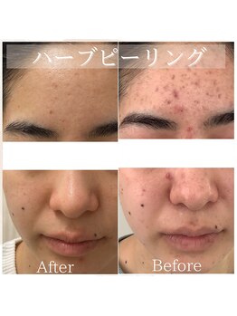 チェリーブロッサム 恵比寿店(CHERRY BLOSSOM)/ハーブピーリング