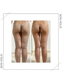 スキンホリック 恵比寿駅前店(SKIN HOLIC)/下半身☆痩身ビフォア＆アフター