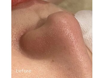 ドクターエイチ 四ツ橋堀江店(Doctor.H)/ハイドロ毛穴洗浄