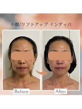 アピ(api)/症例写真【小顔インディバ】