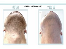 ビビット(BIBITTO)/ヒゲ脱毛ビフォーアフター