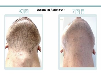 ビビット(BIBITTO)/ヒゲ脱毛ビフォーアフター