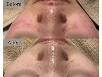 シェリーミル(Cherie Miru)/ニキビ/毛穴/赤ら顔/色むら