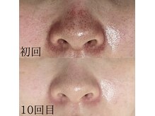 サロンドジェシカ(salon de Jessica)の雰囲気（プラズマフェイシャル　ヒト幹細胞美容液導入☆初回￥9,900）