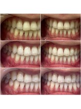 ホワイトニングショップ 高崎店/ビフォーアフターホワイトニング