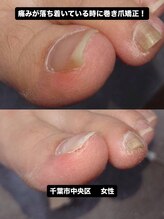 巻き爪じゅん 千葉駅前店/日常的に悩んでいた巻き爪