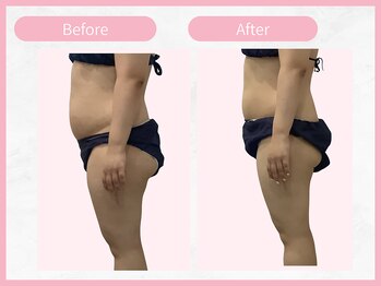 RHB 横浜店/【痩身コース】ビフォーアフター