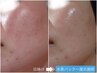 【日焼け後】駆け込み予約大歓迎【今すぐ改善したい赤み肌】高濃度水素パック