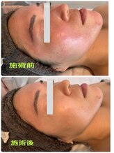 シャルム(Charme)/ピーリングフェイシャル