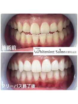 ホワイトニングサロン 京都烏丸店/ホワイトニング施術例