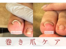 アルヴィス(Arviss)/巻き爪ケア