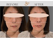 チョコバリ 渋谷店(chocobari)/小顔×リフトアップ(美容鍼)50代