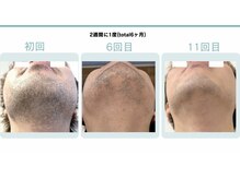 ビビット(BIBITTO)/ヒゲ脱毛ビフォーアフター