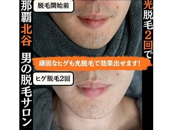 ディースタイル 北谷店(Dstyle)/北谷メンズ脱毛ヒゲBefore after