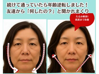 ピュアハリ/沖縄美容鍼 効果