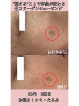 アイリス/生コラーゲン×プラズマで肌改善